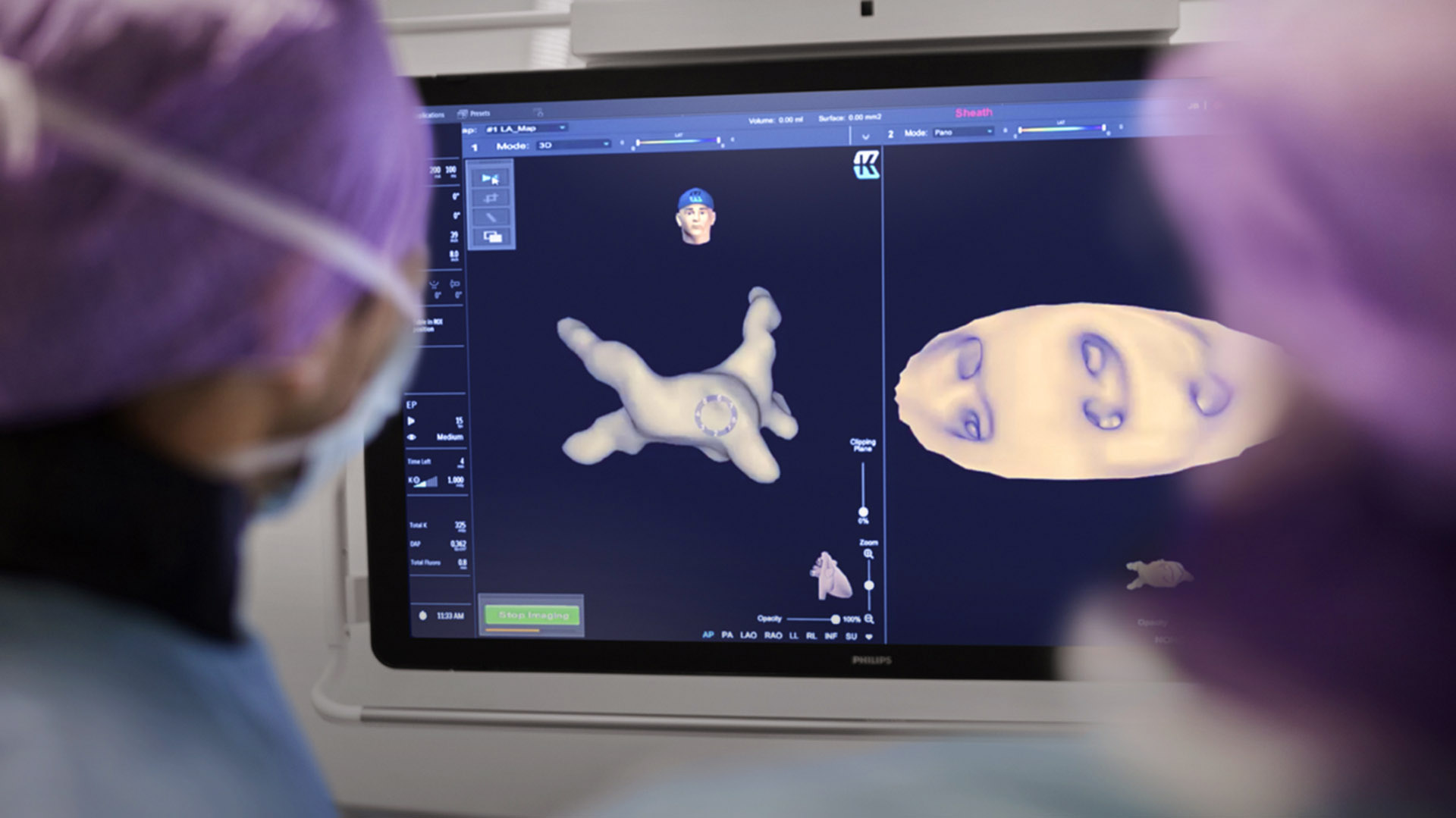 How a new way of visualizing the heart can help fight atrial fibrillation